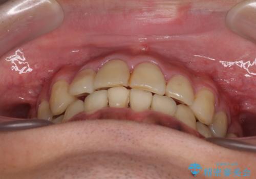 重なって磨きにくい上下の前歯 ワイヤー装置での抜歯矯正の治療後