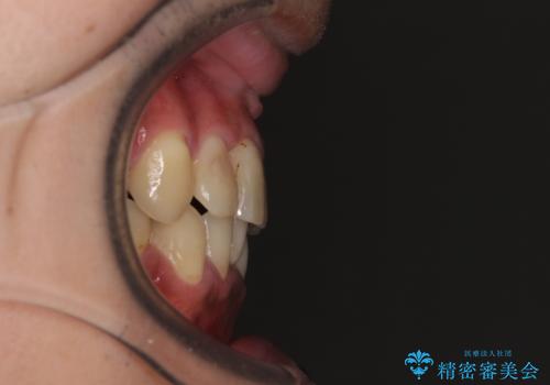重なって磨きにくい上下の前歯 ワイヤー装置での抜歯矯正の治療後