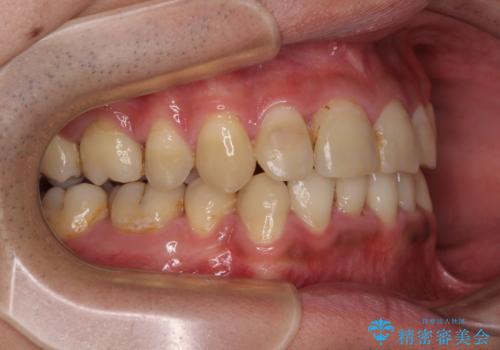 重なって磨きにくい上下の前歯 ワイヤー装置での抜歯矯正の治療後