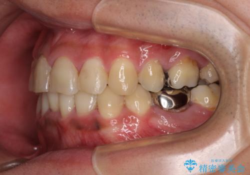 重なって磨きにくい上下の前歯　ワイヤー装置での抜歯矯正の治療後