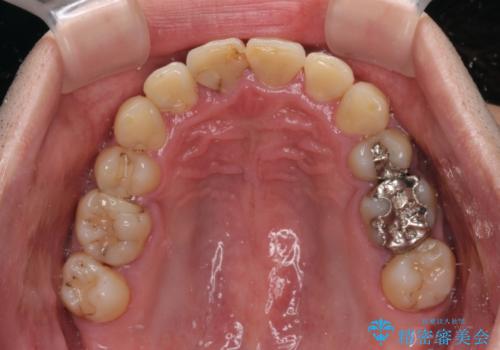 重なって磨きにくい上下の前歯 ワイヤー装置での抜歯矯正の治療後