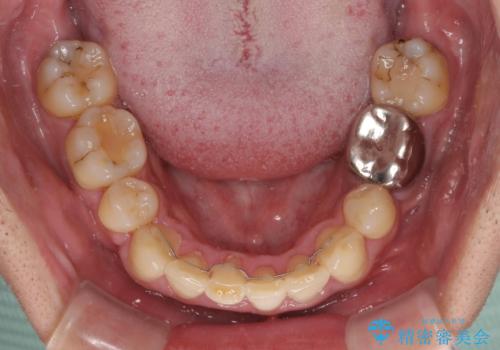 重なって磨きにくい上下の前歯 ワイヤー装置での抜歯矯正の治療後
