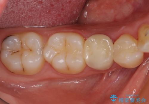 欠けてしまったプラスチック オールセラミッククラウンで土台の歯を守るの治療後
