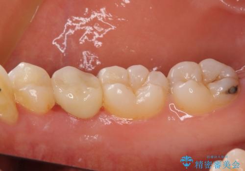 欠けてしまったプラスチック オールセラミッククラウンで土台の歯を守るの治療後