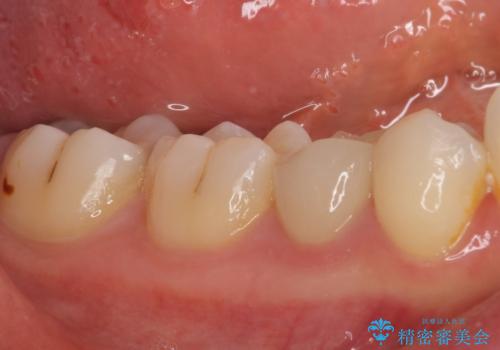 欠けてしまったプラスチック オールセラミッククラウンで土台の歯を守るの治療後