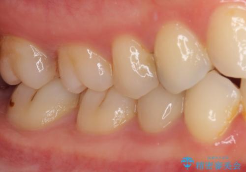 欠けてしまったプラスチック オールセラミッククラウンで土台の歯を守るの治療後