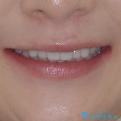 前歯のデコボコと奥歯の咬み合わせをインビザラインで改善の治療後（顔貌）