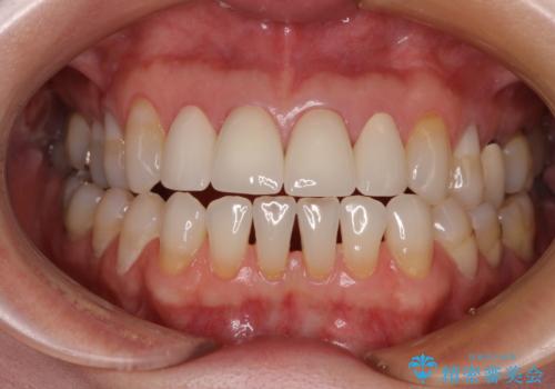 ひどすぎる前歯の仮歯　オールセラミッククラウンで自然な前歯にの治療後