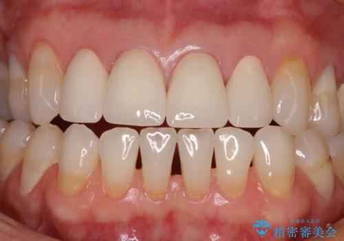 ひどすぎる前歯の仮歯 オールセラミッククラウンで自然な前歯にの治療後