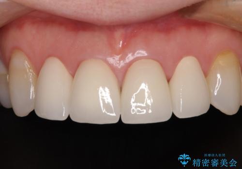 ひどすぎる前歯の仮歯 オールセラミッククラウンで自然な前歯にの治療後