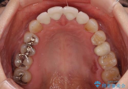 ひどすぎる前歯の仮歯 オールセラミッククラウンで自然な前歯にの治療後