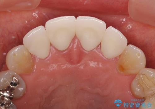 ひどすぎる前歯の仮歯 オールセラミッククラウンで自然な前歯にの治療後
