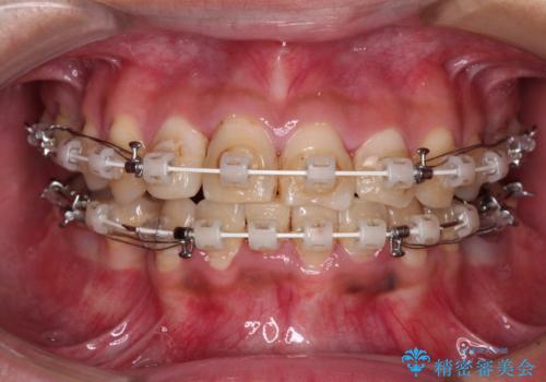 重なって磨きにくい上下の前歯 ワイヤー装置での抜歯矯正の治療中