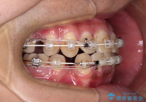 重なって磨きにくい上下の前歯 ワイヤー装置での抜歯矯正の治療中