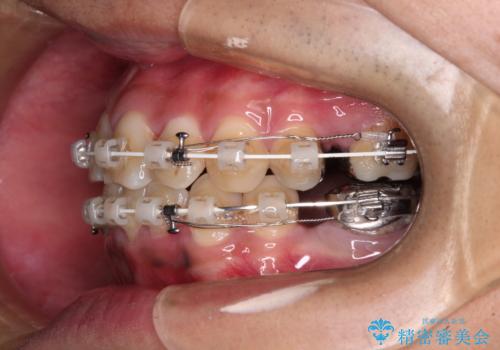 重なって磨きにくい上下の前歯　ワイヤー装置での抜歯矯正の治療中