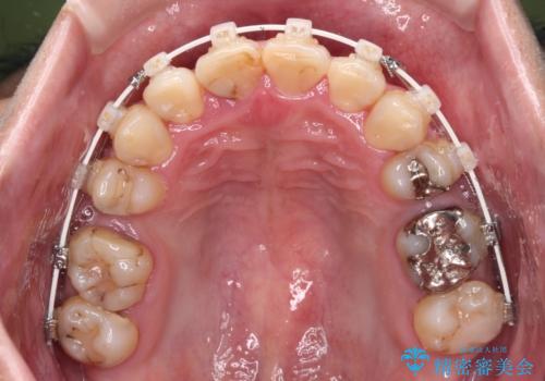 重なって磨きにくい上下の前歯 ワイヤー装置での抜歯矯正の治療中