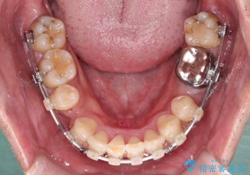 重なって磨きにくい上下の前歯　ワイヤー装置での抜歯矯正の治療中