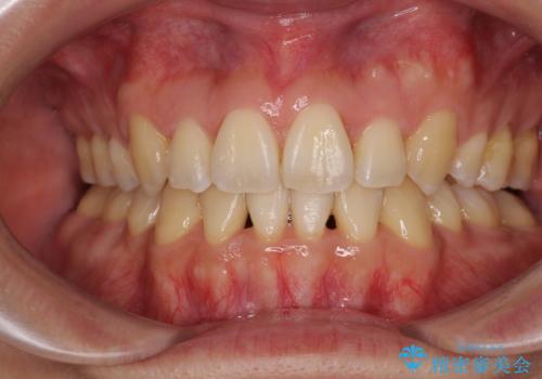 重なり合って磨きにくい前歯 ワイヤー装置での抜歯矯正の症例 治療後