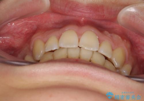 重なり合って磨きにくい前歯 ワイヤー装置での抜歯矯正の治療後