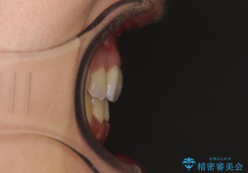 重なり合って磨きにくい前歯 ワイヤー装置での抜歯矯正の治療後