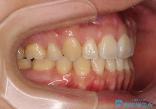 重なり合って磨きにくい前歯　ワイヤー装置での抜歯矯正の治療後