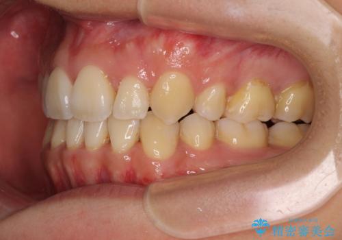 重なり合って磨きにくい前歯　ワイヤー装置での抜歯矯正の治療後