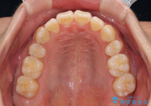 重なり合って磨きにくい前歯 ワイヤー装置での抜歯矯正の治療後