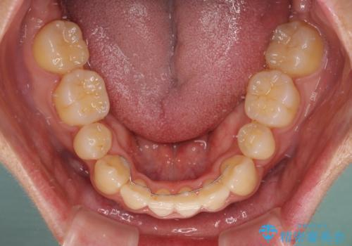 重なり合って磨きにくい前歯 ワイヤー装置での抜歯矯正の治療後