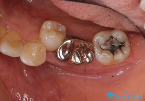 奥歯が割れた インプラントは不向き 部分矯正後、ブリッジで治療の治療前