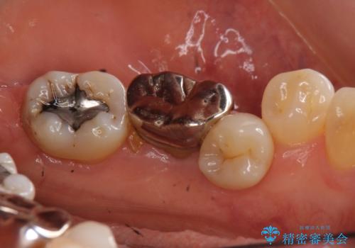 奥歯が割れた インプラントは不向き 部分矯正後、ブリッジで治療の治療前