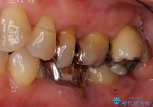奥歯が割れた　インプラントは不向き　部分矯正後、ブリッジで治療の症例 治療前