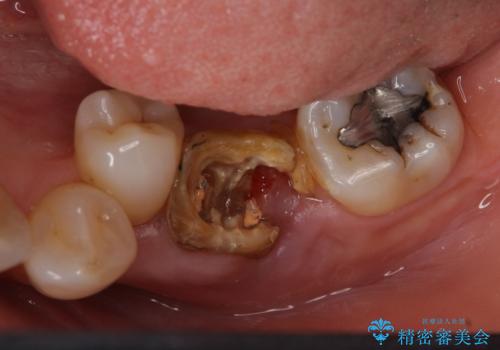 奥歯が割れた インプラントは不向き 部分矯正後、ブリッジで治療の治療前