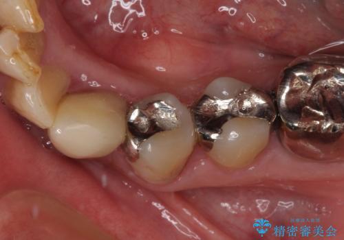 抜歯と言われた歯　部分矯正と歯周外科処置で抜かずに保存の治療後