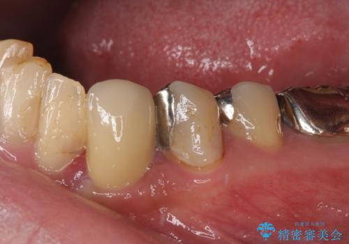 抜歯と言われた歯　部分矯正と歯周外科処置で抜かずに保存の症例 治療後