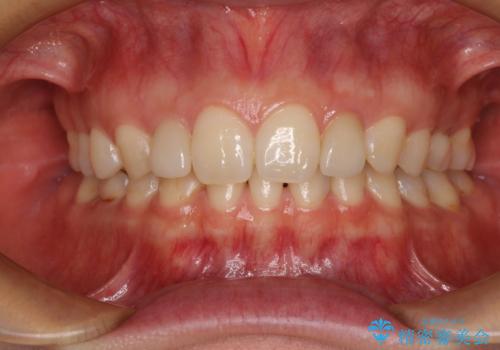 境目が目立つラミネートベニアを作り替えの治療後