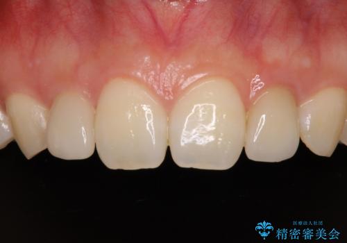 境目が目立つラミネートベニアを作り替えの症例 治療後