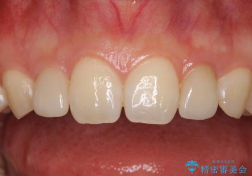 境目が目立つラミネートベニアを作り替えの治療後