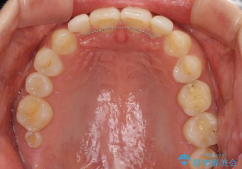 境目が目立つラミネートベニアを作り替えの治療後