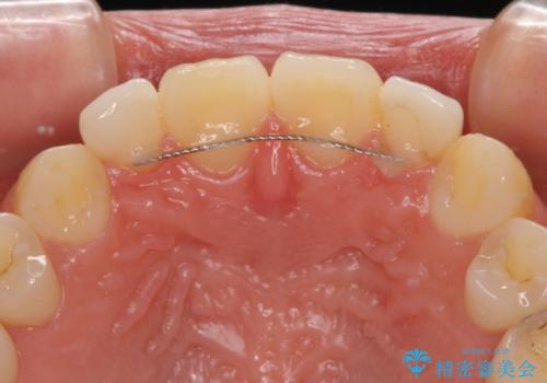 境目が目立つラミネートベニアを作り替えの治療後