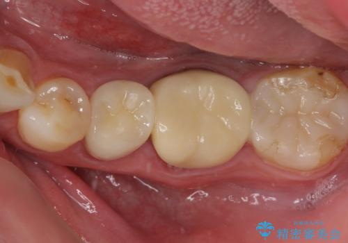 詰め物の外れてしまった奥歯　部分矯正で歯列を整えてから補綴治療の治療後