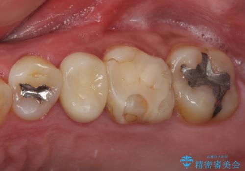 詰め物の外れてしまった奥歯 部分矯正で歯列を整えてから補綴治療の治療後