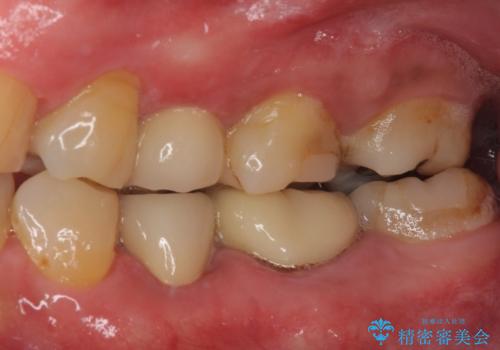 詰め物の外れてしまった奥歯 部分矯正で歯列を整えてから補綴治療の症例 治療後