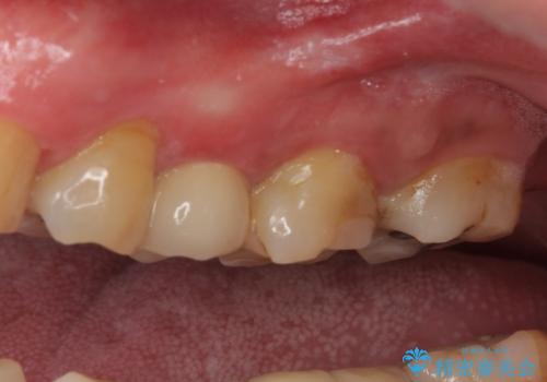 詰め物の外れてしまった奥歯 部分矯正で歯列を整えてから補綴治療の治療後
