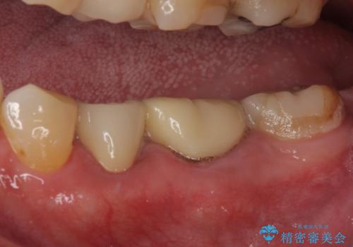 詰め物の外れてしまった奥歯 部分矯正で歯列を整えてから補綴治療の治療後
