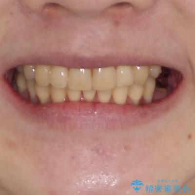 八重歯と先天欠損の歯列　ワイヤー矯正ですっきりとの治療後（顔貌）