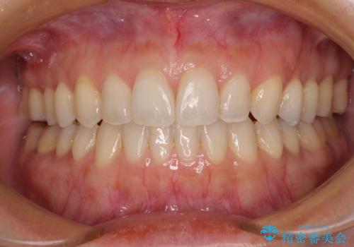 【モニター】狭い上顎歯列とオープンバイト 急速拡大装置を用いた矯正治療の症例 治療後