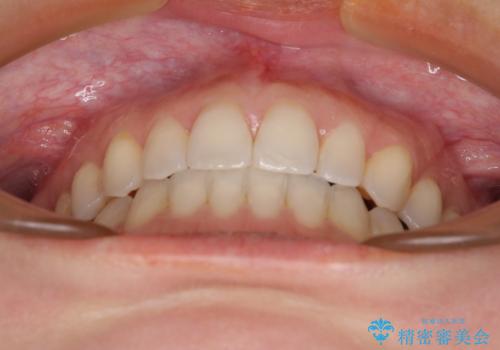 【モニター】狭い上顎歯列とオープンバイト　急速拡大装置を用いた矯正治療の治療後