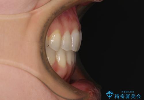 【モニター】狭い上顎歯列とオープンバイト 急速拡大装置を用いた矯正治療の治療後