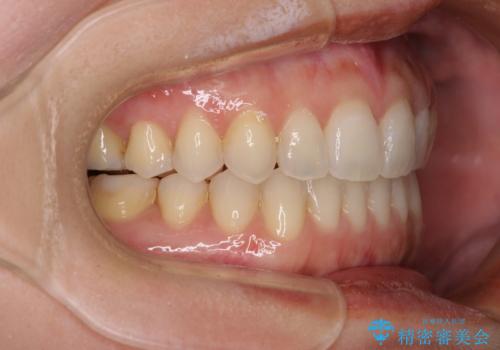 【モニター】狭い上顎歯列とオープンバイト 急速拡大装置を用いた矯正治療の治療後
