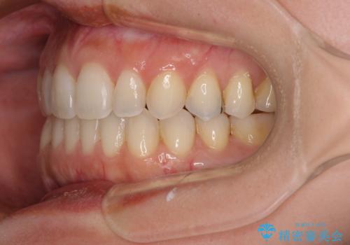 【モニター】狭い上顎歯列とオープンバイト　急速拡大装置を用いた矯正治療の治療後
